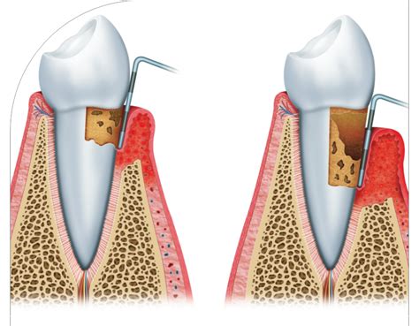 Parodontologia Mgo Odontoiatria