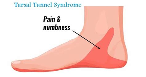 Tarsal Tunnel Syndrome By Orthofixar Orthopedic Medium