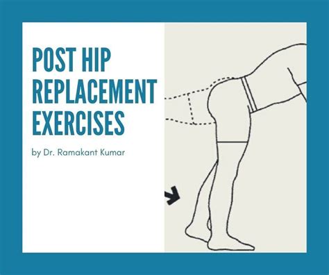 Here Know About The Best Post Hip Replacement Exercises To Practice