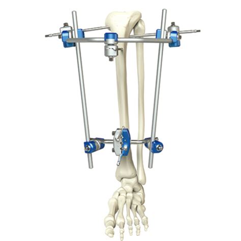 Proximal Tibia External Fixator Orthopedic Drills Uk
