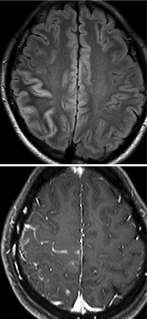 Magnetic Resonance Imaging Diagnosis Of Demyelinating Diseases An Update Miki 2019