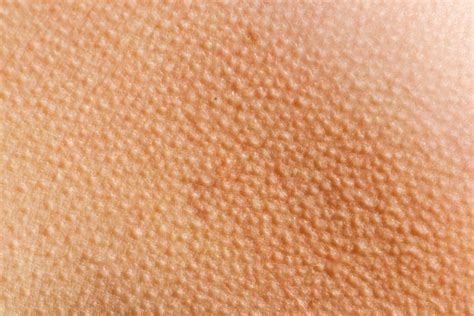 What Are Goose Bumps