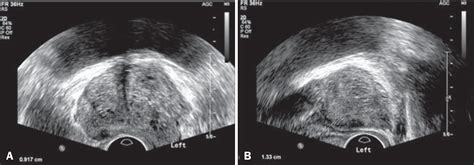 Transrectal Ultrasound Prostate Biopsy