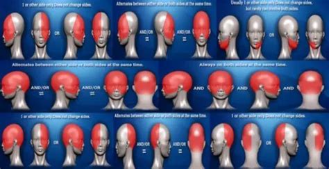 Headache Chart Location And Symptoms For Headaches Types