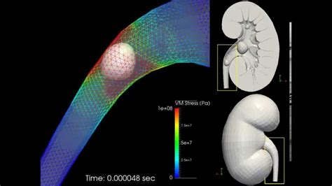 Multiphysics Simulation Of Shock Wave Lithotripsy Swl Youtube