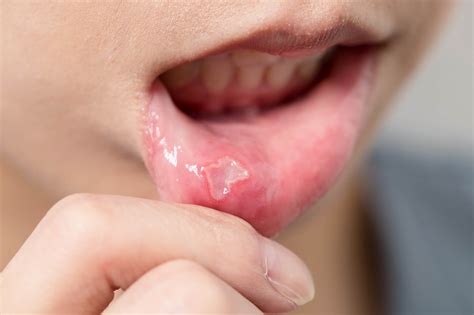 Canker Sores And Mouth Ulcers Can Be Irritating In Your Mouth