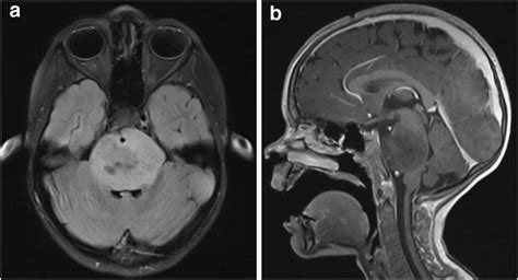 Mri Images Of A Radiographically Classic Dipg Including A Axial T2