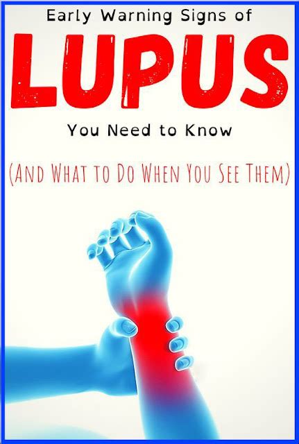 Early Warning Signs Of Lupus You Need To Know And What To Do The