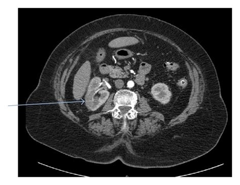 Ct Abdomen And Pelvis With And Without Contrast Renal Protocol