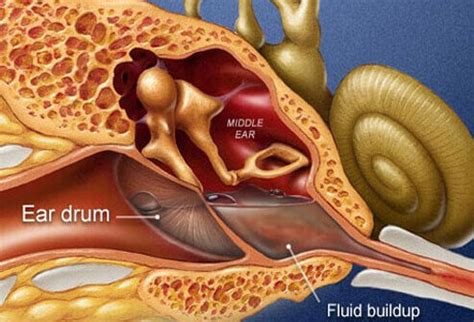 Ear Infection Symptoms, Causes, and Treatment