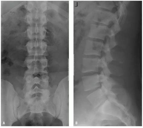 Learn how the procedure is performed and if there are any safety risks. Imaging Thoracolumbar Spine Trauma | Radiology Key