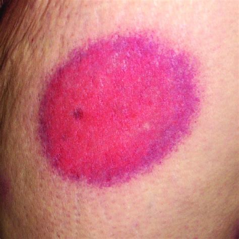 Bullous Fixed Drug Eruption On The Left Upper Thigh Download
