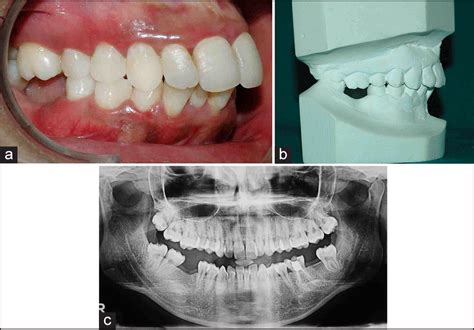 Intrusion Of Over Erupted Maxillary First Molar Using A Mandibular Removable Acrylic Bite Plate