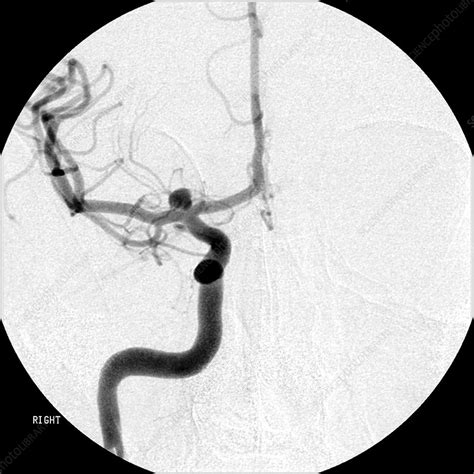Cerebral Angiogram Of Aneurysm Stock Image C Science Photo Library