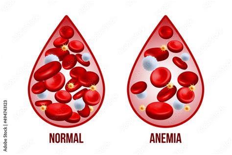 Iron Deficiency Anemiathe Difference Of Anemia Amount Of Red Blood