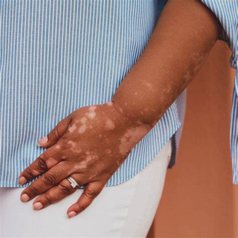 Need To Know About Vitiligo As An Autoimmune Disease Living Dappled