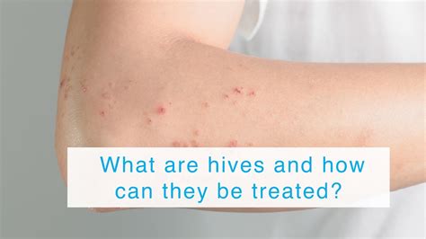What Are Hives And How Can They Be Treated Youtube