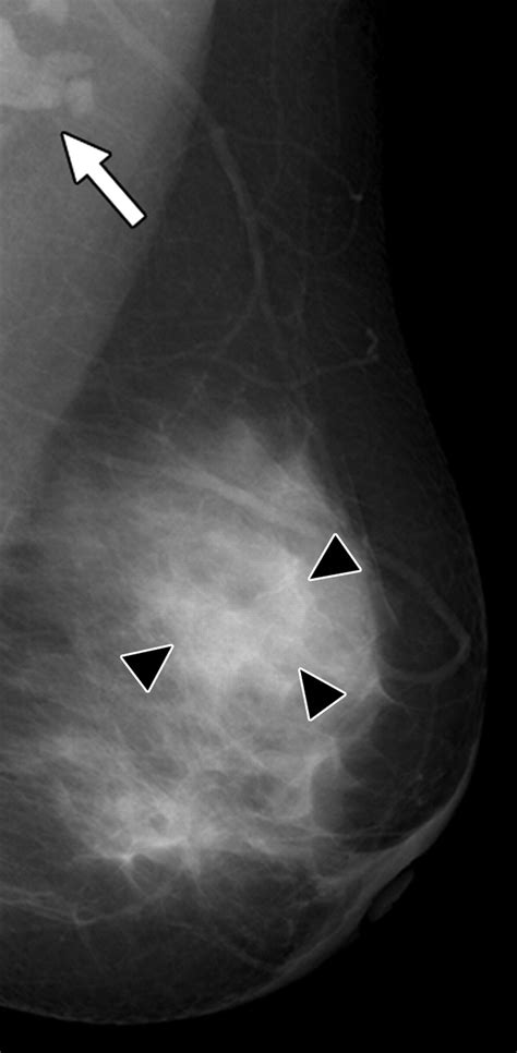 Preoperative Sonographic Classification Of Axillary Lymph Nodes In