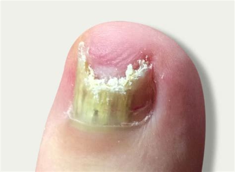 Fungal Nails Davenport House Clinic