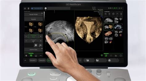 Ge Healthcare Unveils Ai Enhanced Womens Health Ultrasound