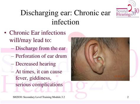 Ppt Detection Of Common Ear Diseases In The Community Part 2