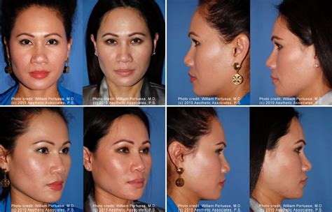 Flat Nose Before And After Photo Gallery Nose Surgery Photos