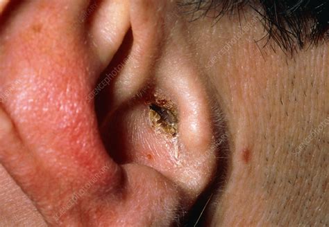 Otitis Externa Infected Outer Ear Of Male Patient Stock Image M157