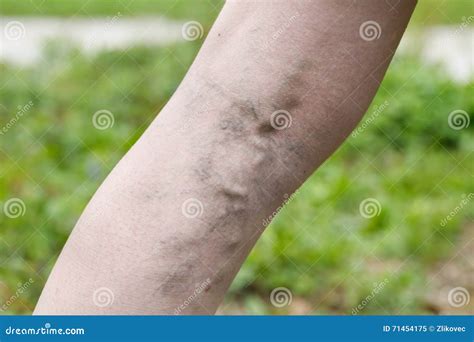 Painful Varicose And Spider Veins On Womans Legs Stock Photo