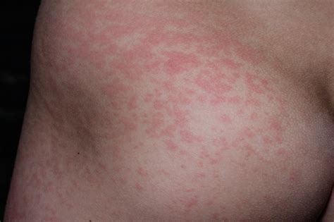 When To Worry About Skin Rash In Adults And Childerns Skin Rash