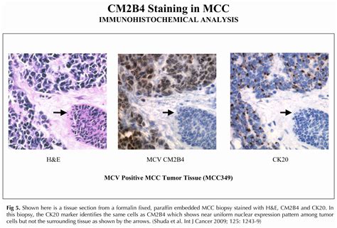 Clinical characteristics of merkel cell carcinoma at diagnosis in 195 patients: Merkel Cell Polyomavirus | The Chang-Moore Lab Cancer Virology Program | University of Pittsburgh