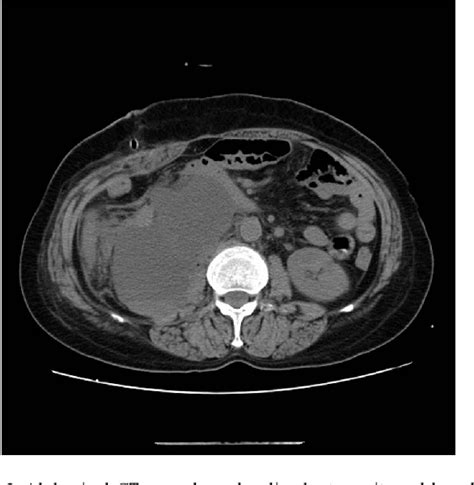 Figure 2 From Treatment Of Lymphatic Leakage After Retroperitoneal