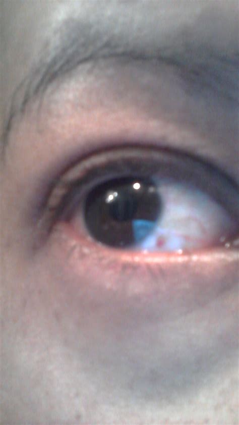 I Have Tiny Red Spot In White Of Eye For 6 Months Now I Kept