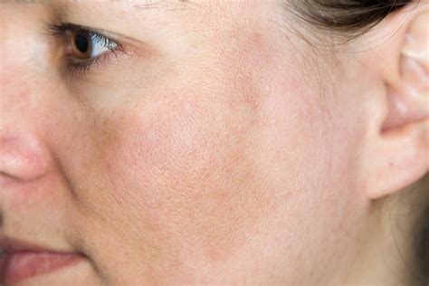Sun Damaged Skin Causes And Effect Arsenault Dermatology