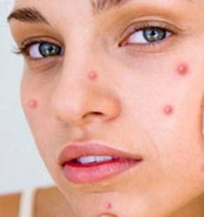 What Causes Pimples New Health Advisor