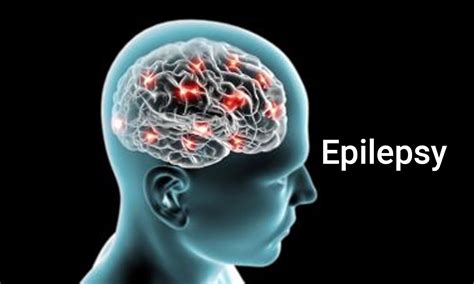 Gejala Epilepsi Penyebab Epilepsi Itu Apa Saja Yuk Kenali Brain And Spine