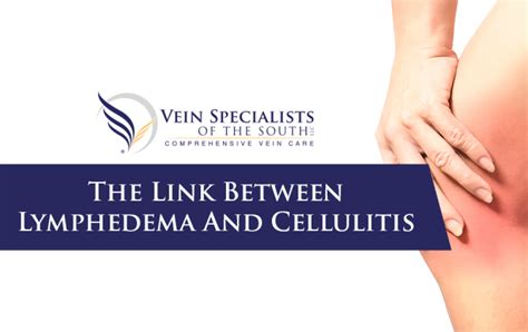 Cellulitis And Lymphedema Vein Specialists Of The South Vein