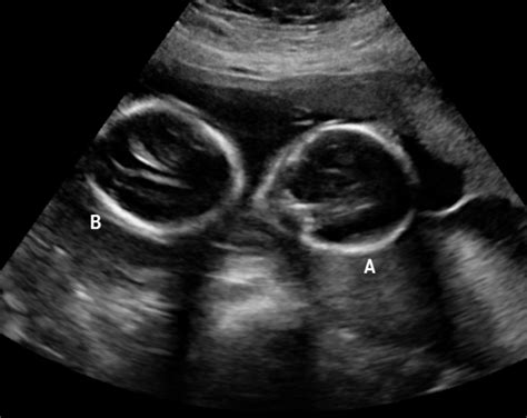 Early Twins Ultrasoundpng