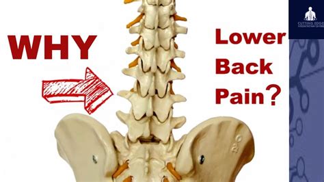 Four Most Common Causes Of Back Pain Youtube