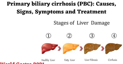 Primary Biliary Cirrhosis Pbc Causes Signs Symptoms And Treatment