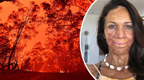 Turia Pitt Reveals Nightmares Trauma Of Nsw Bushfires