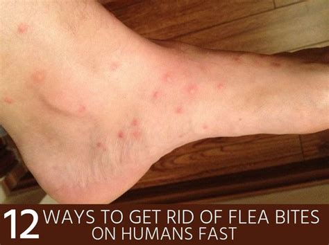 The answer is yes, they often do. How to Get Rid of Flea Bites on Humans Fast (With images ...