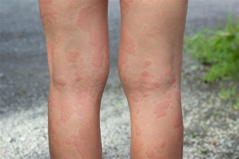 Skin Allergies Legs Women Gupta Allergy Allergy And Asthma Specialists