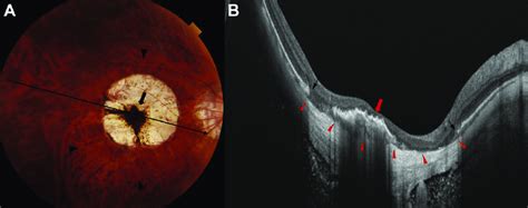 Fundus Photograph And Swept Source Optical Coherence Tomography