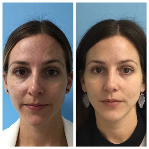 Collection 94 Pictures Ipl Photofacial Before And After Pictures Stunning