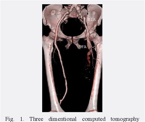 Figure 1 From Surgical Management Of Isolated True Femoral Artery