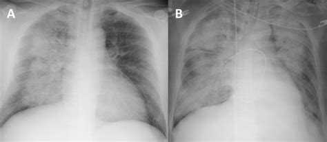 Unilateral Cardiogenic Pulmonary Edema Journal Of Cardiology Cases