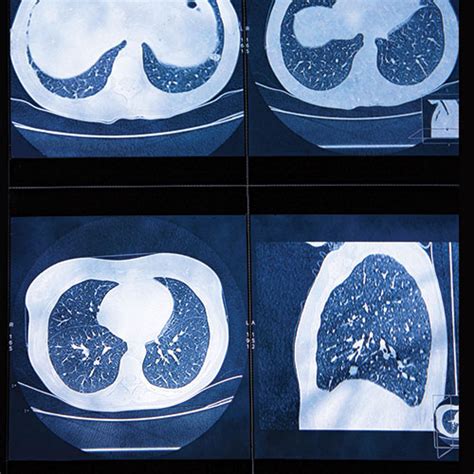 High Resolution Ct Of The Lung
