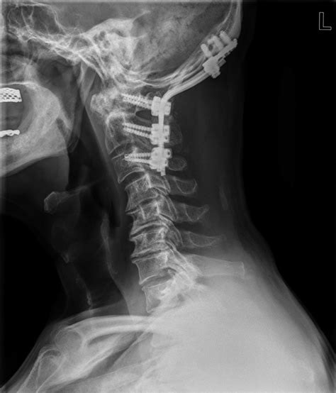 Postoperative Cervical Lateral X Ray Showed Occipital C1 Lateral