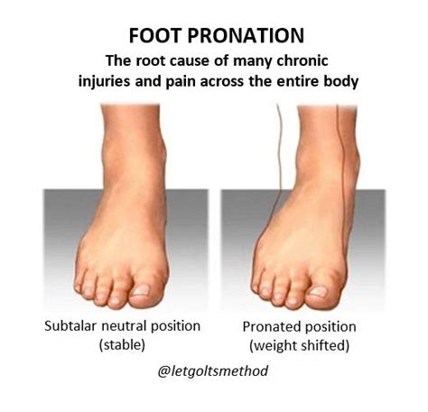 What Causes Pronation Of Foot