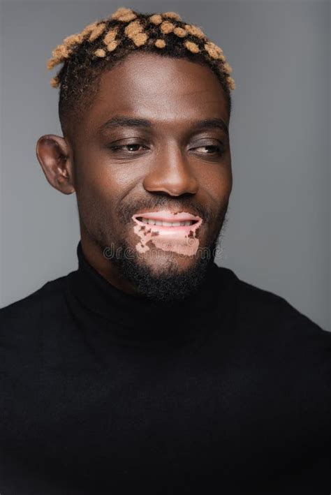 Joyful African American Man With Vitiligo Stock Image Image Of